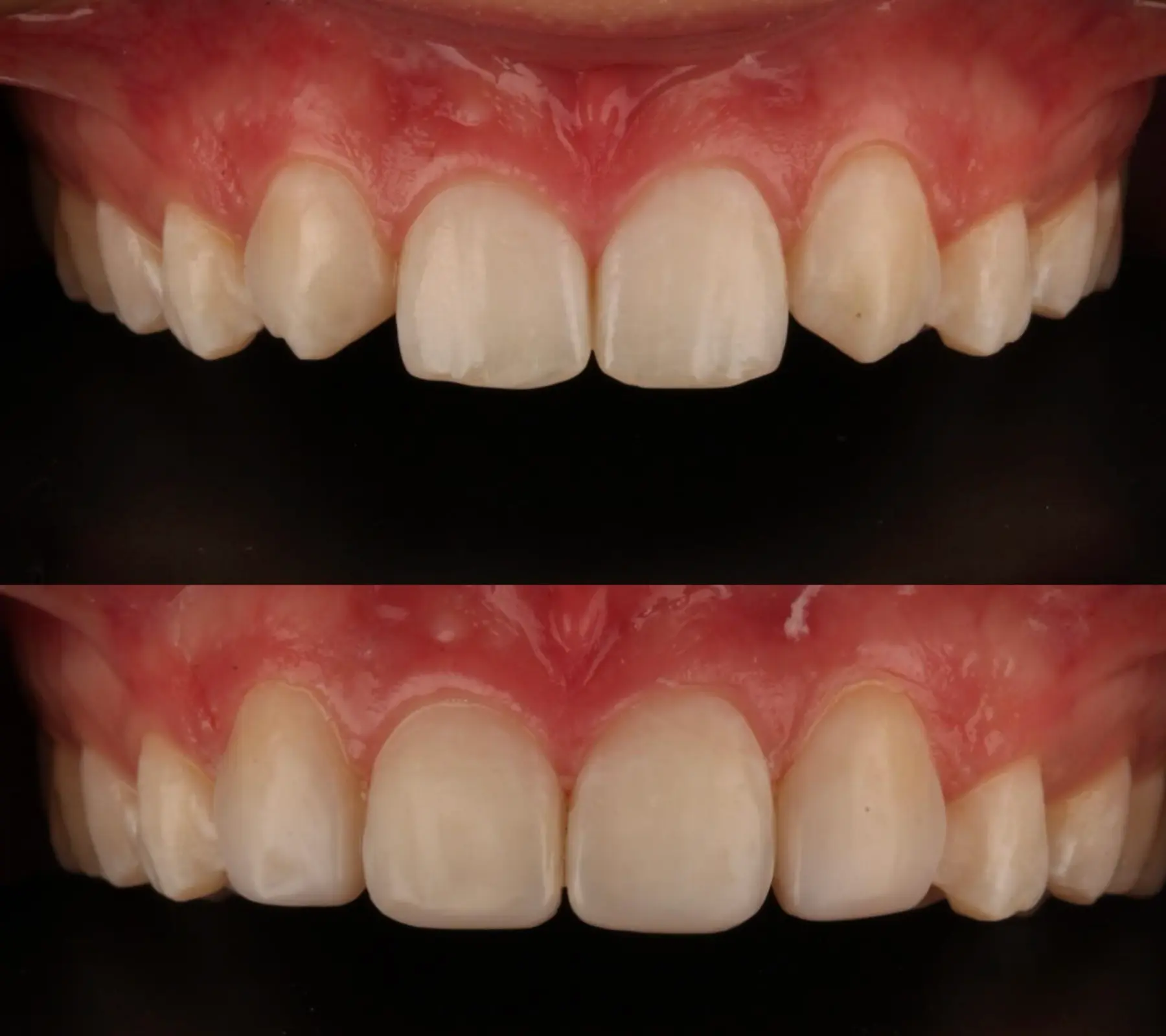 Composite Bonding