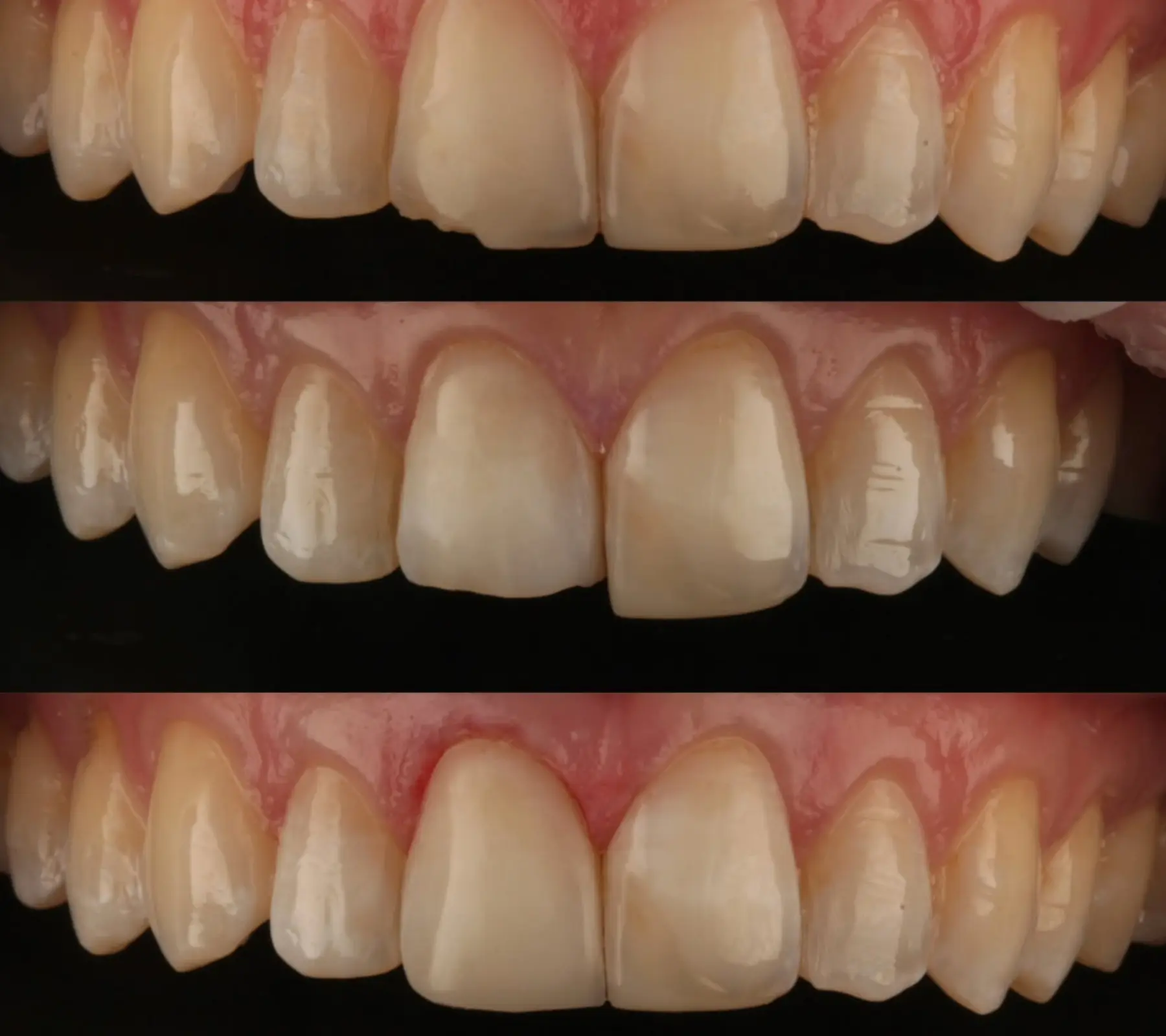 Composite Bonding