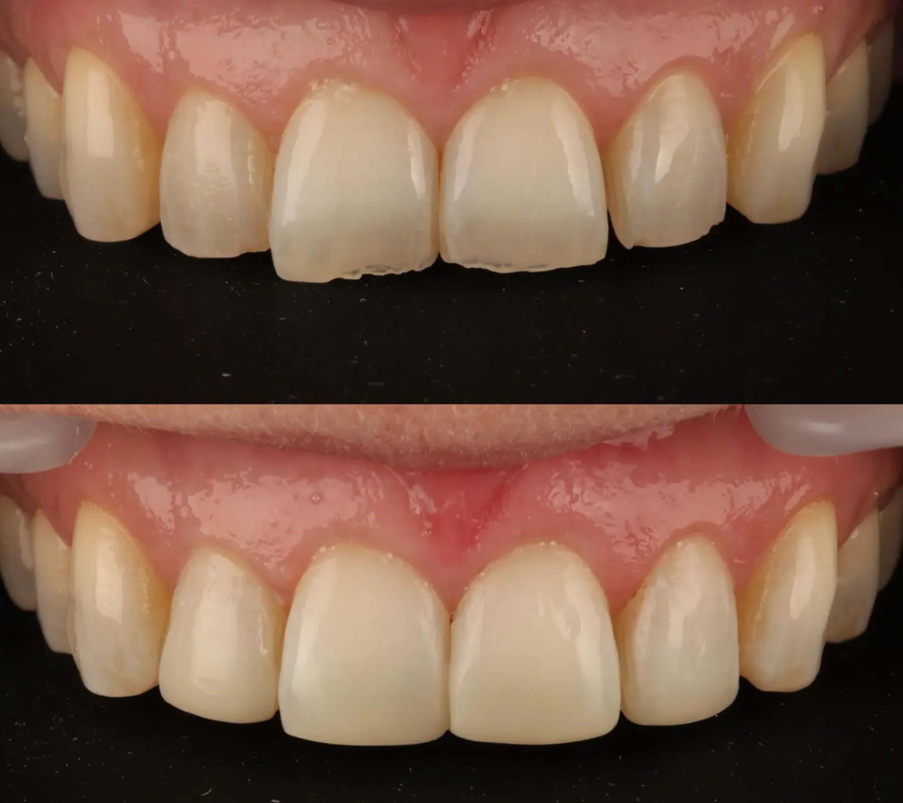 Composite Bonding
