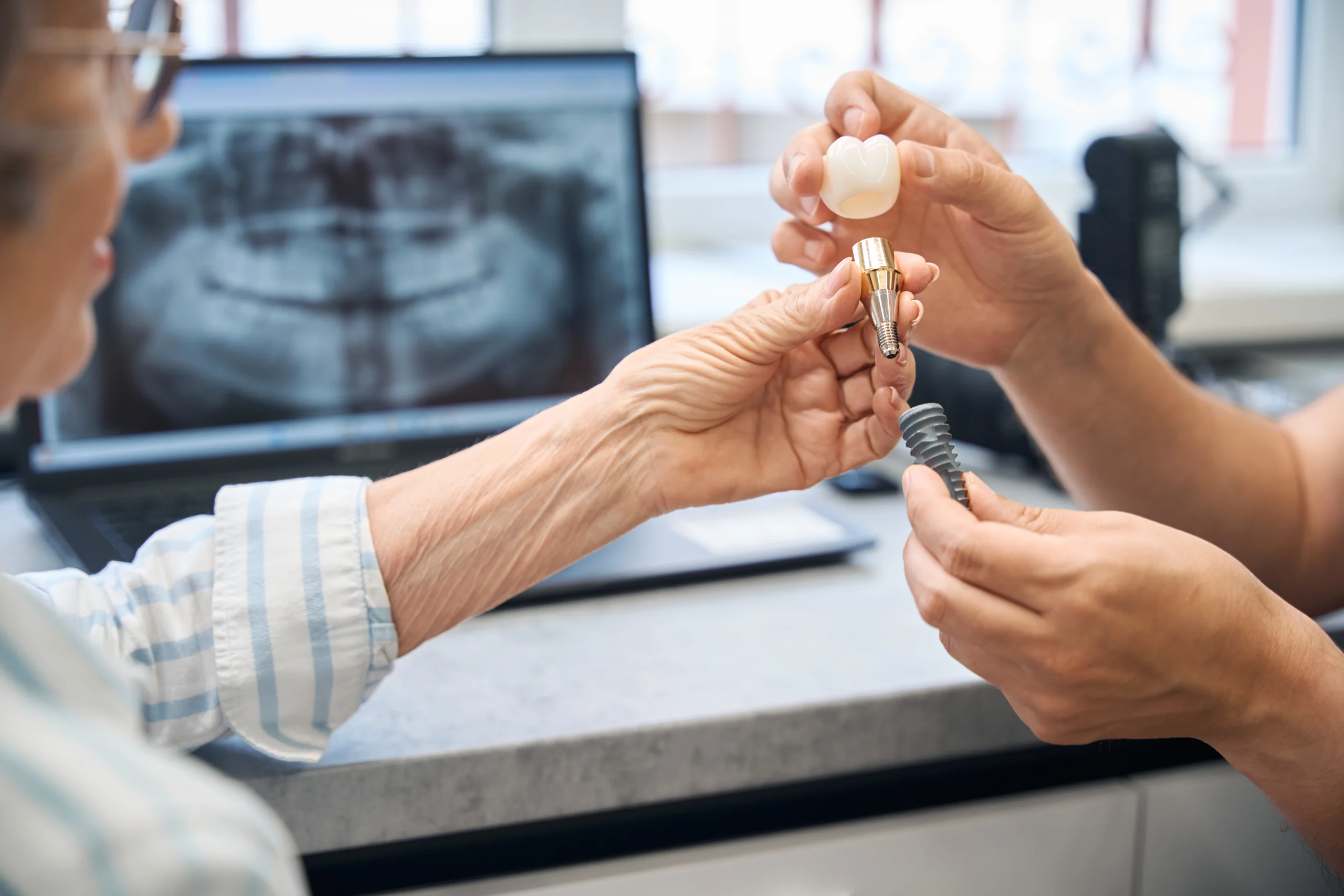 Dental implant at Parchment Street Dental Winchester