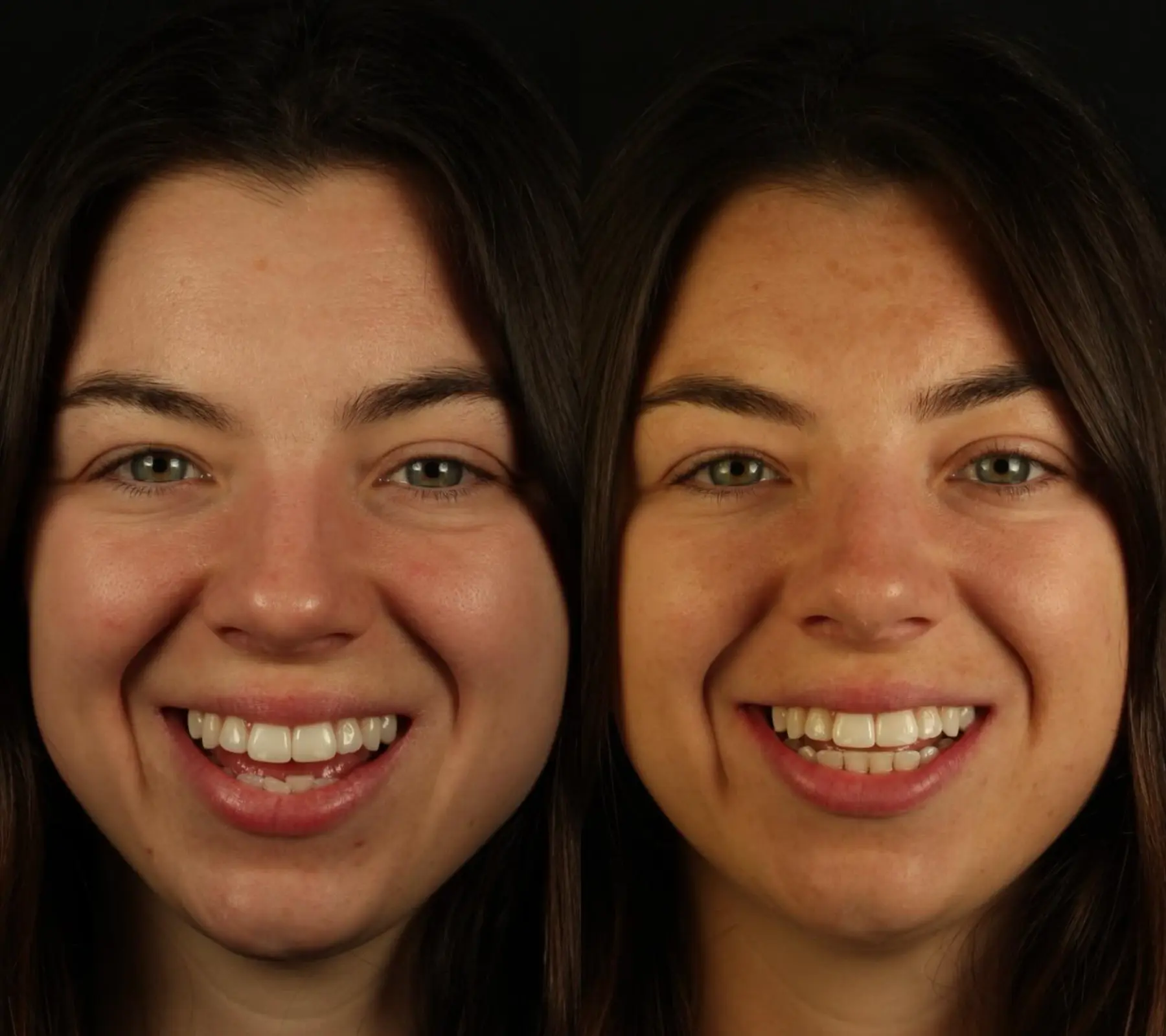 Invisalign