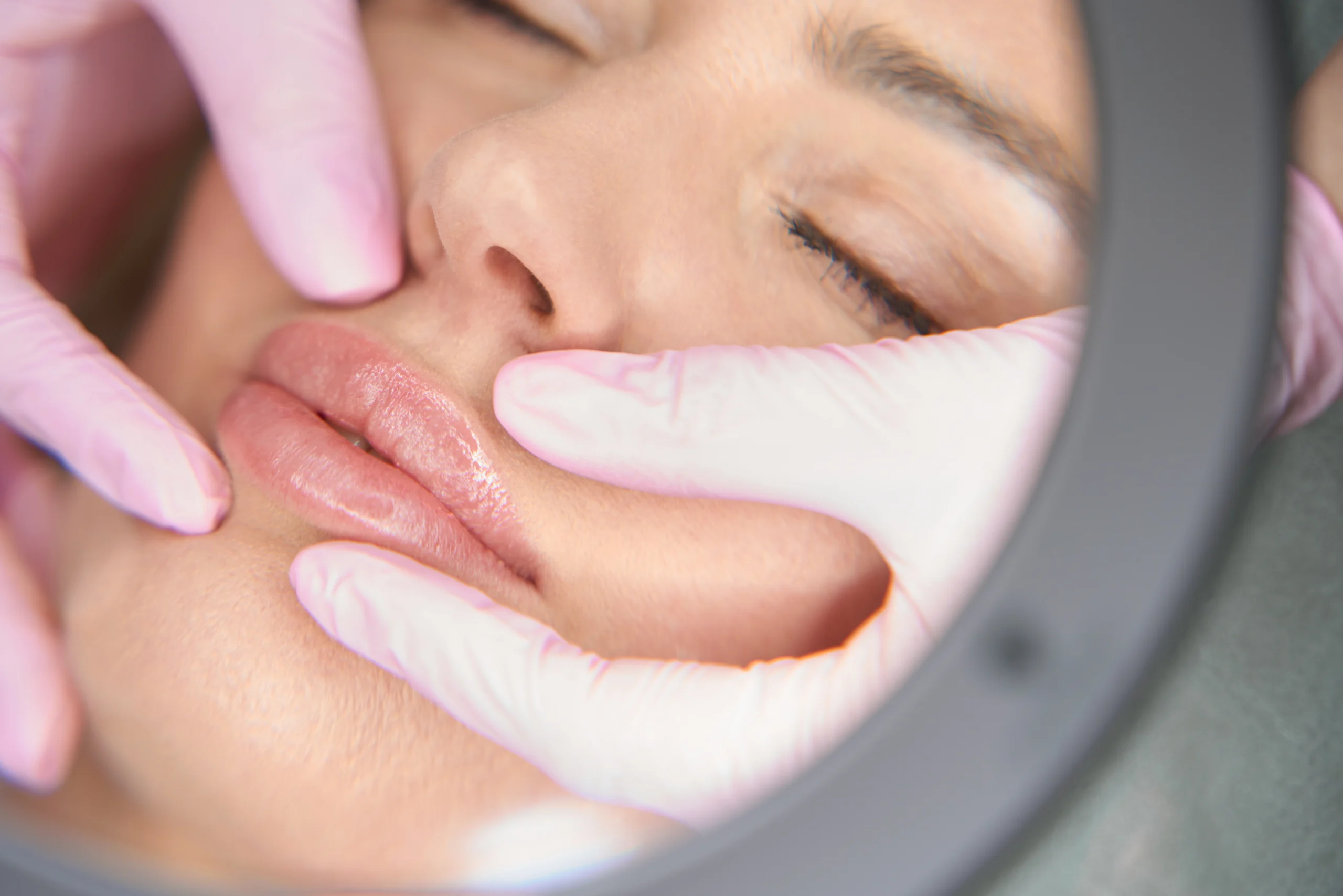 Lip Fillers Winchester