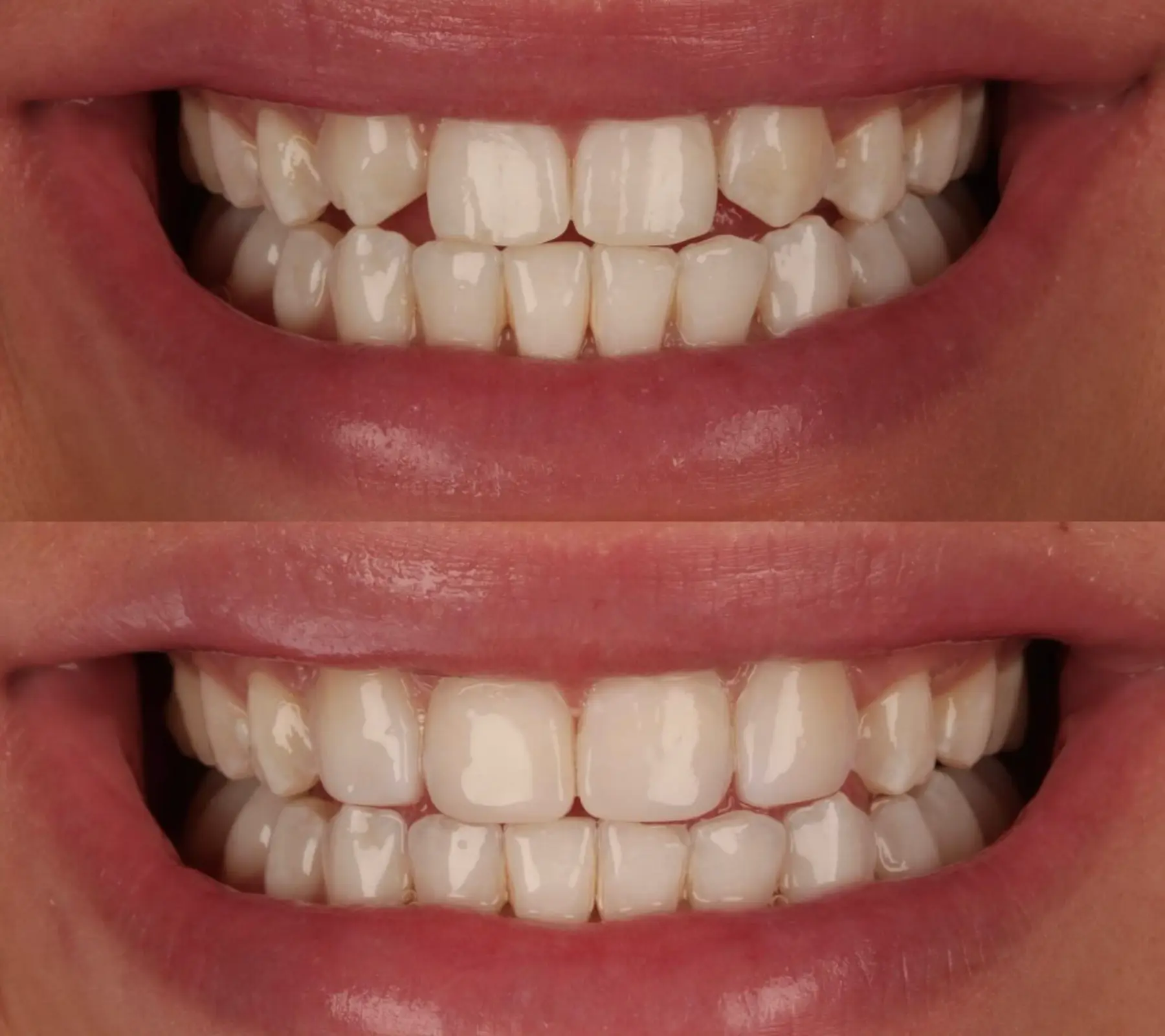 Whitening & Bonding