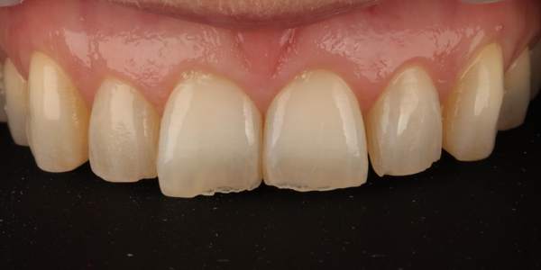 Chipped teeth