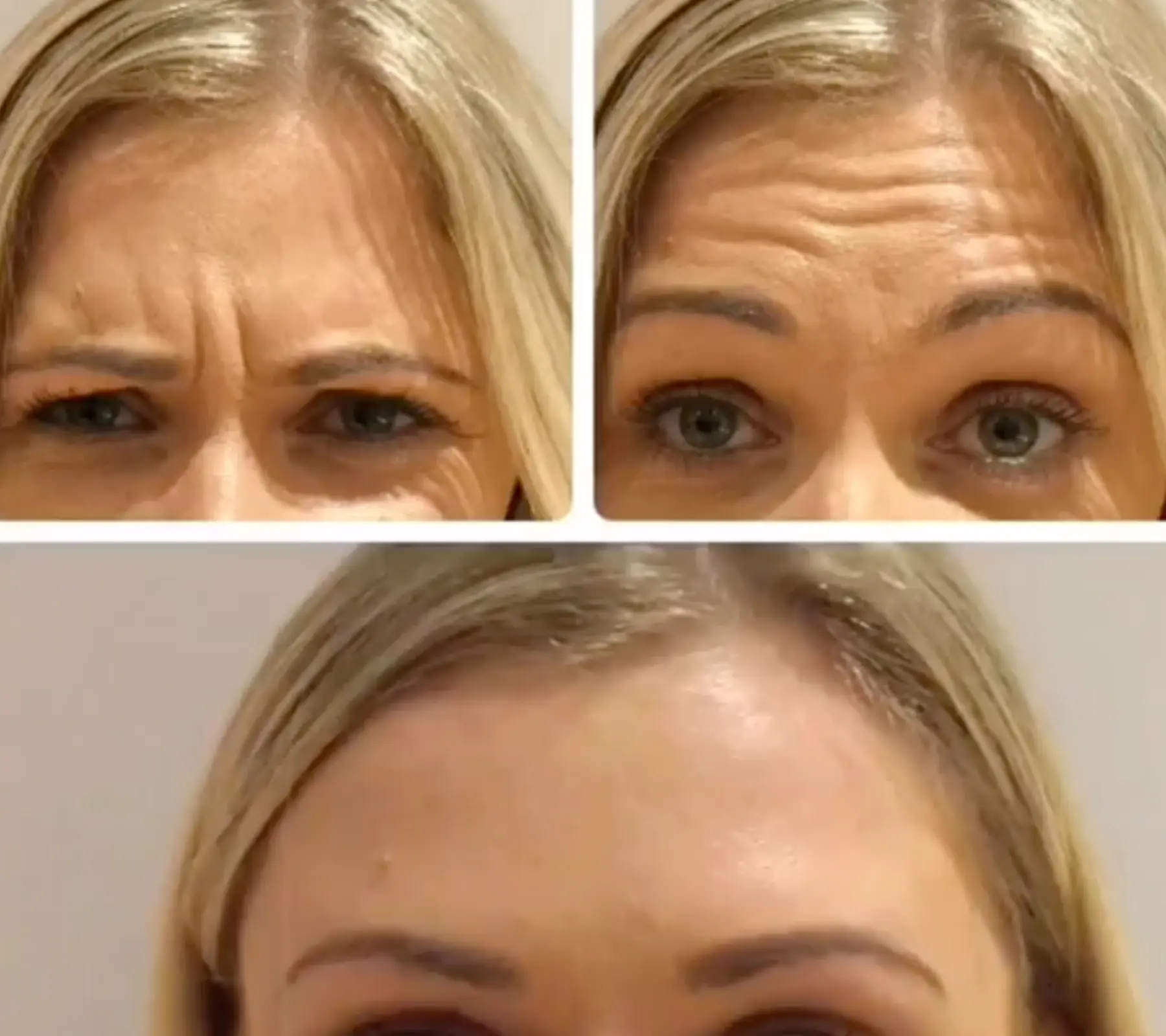 Forehead Lines