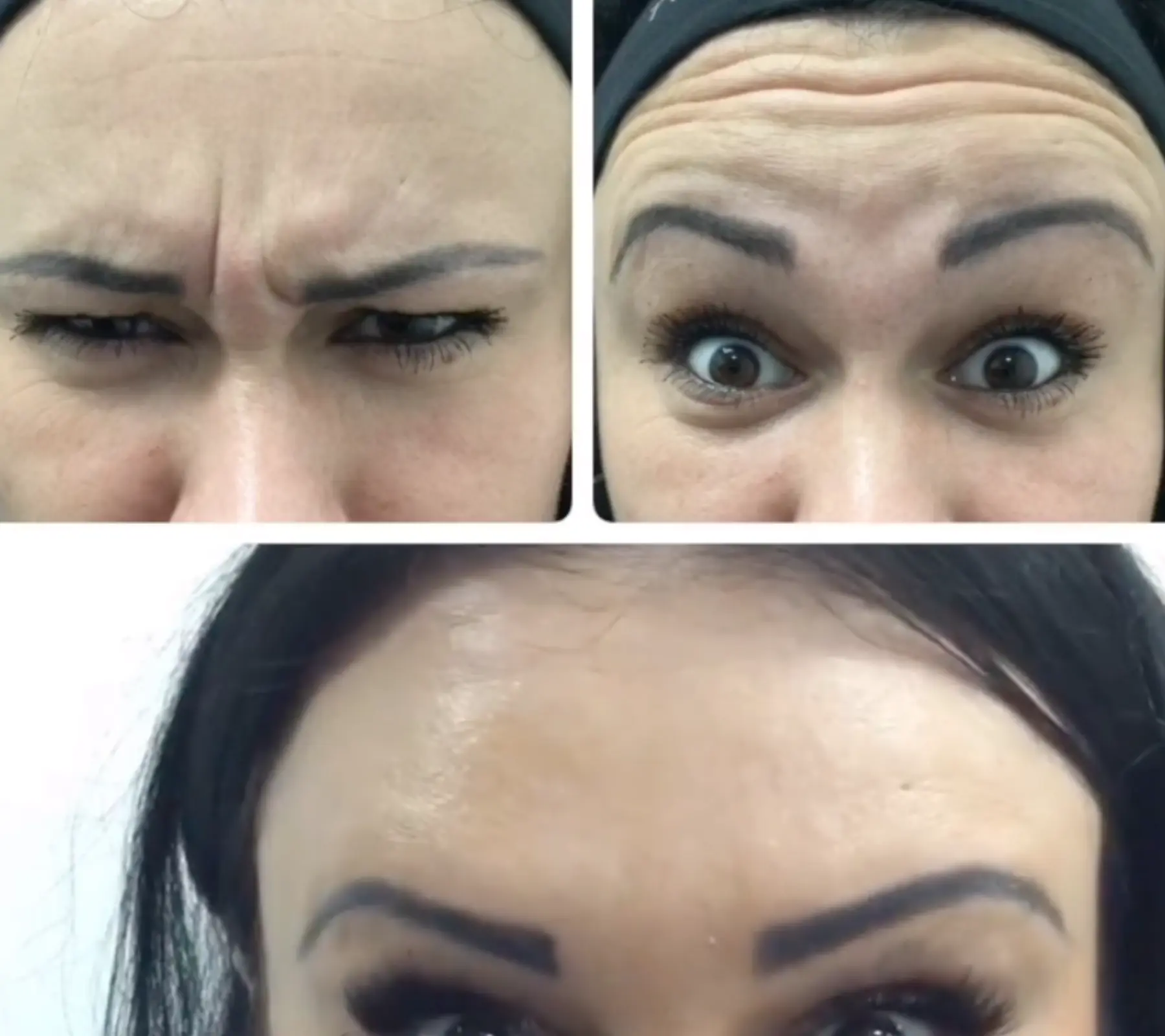 Forehead Lines