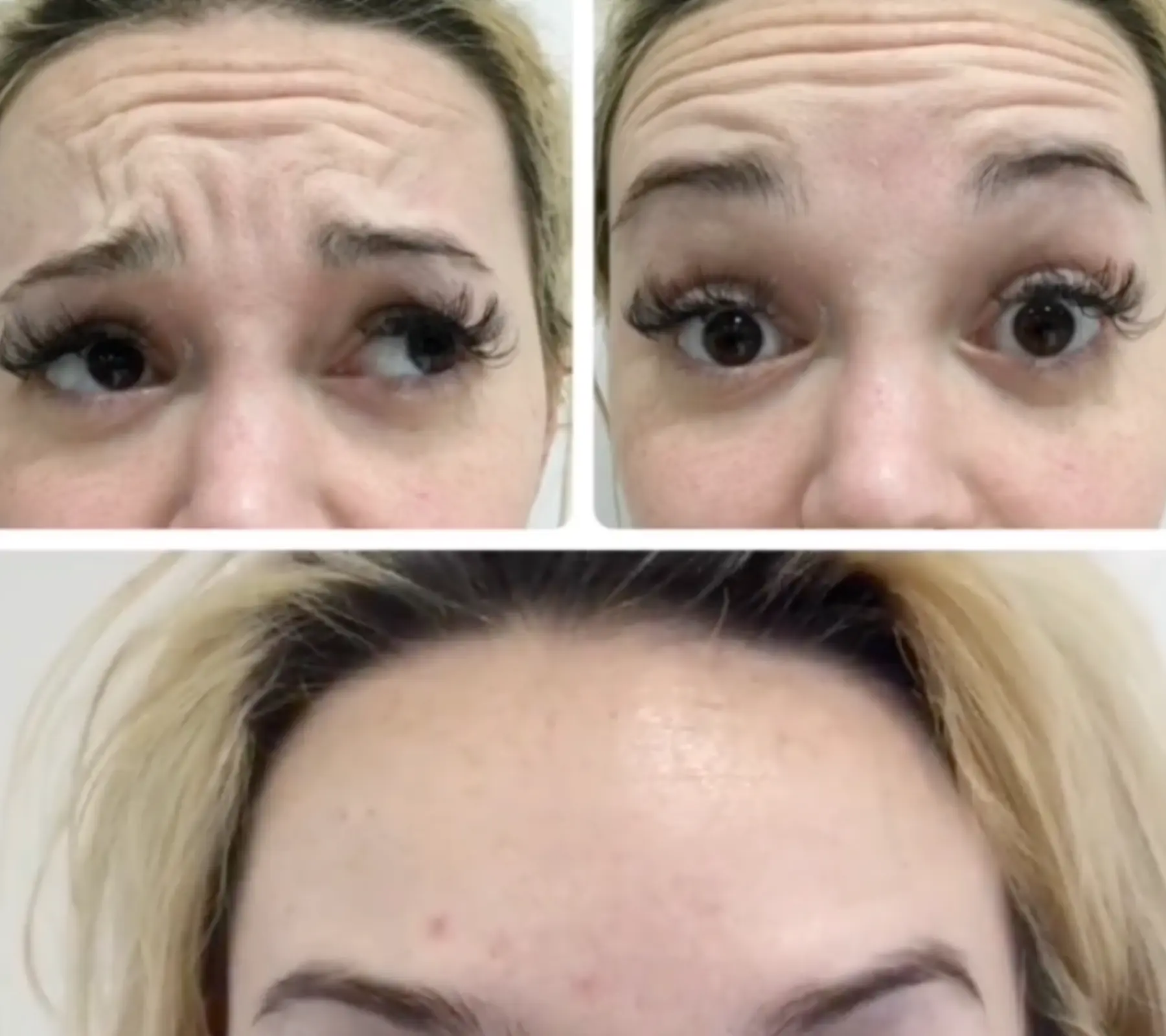 Forehead Lines
