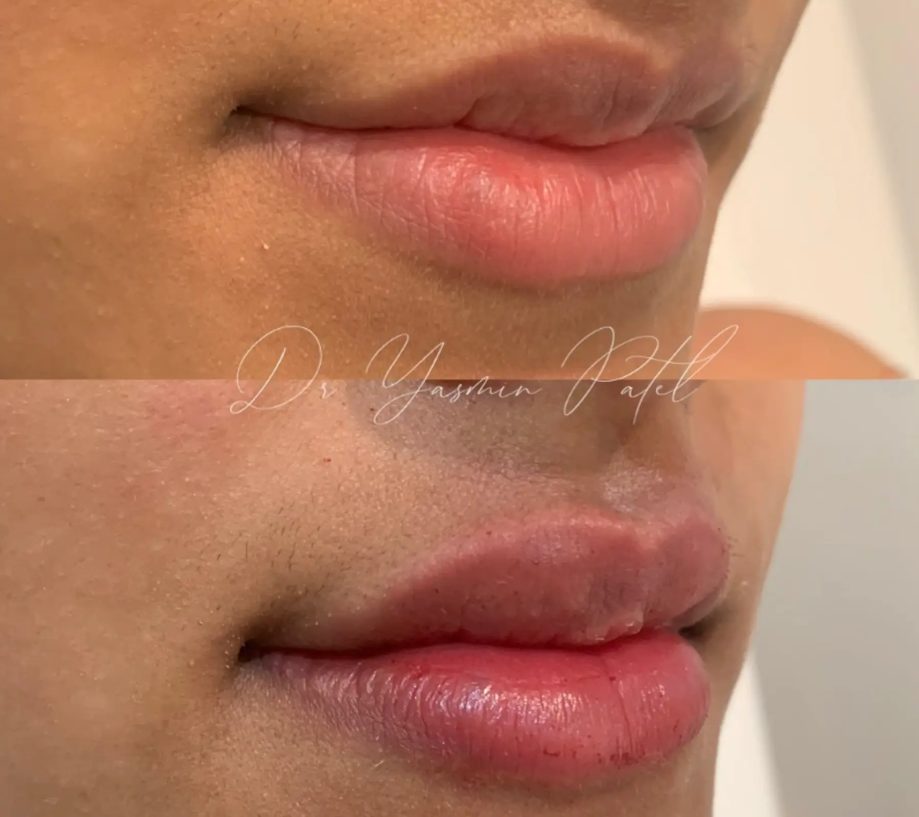 Lip Fillers