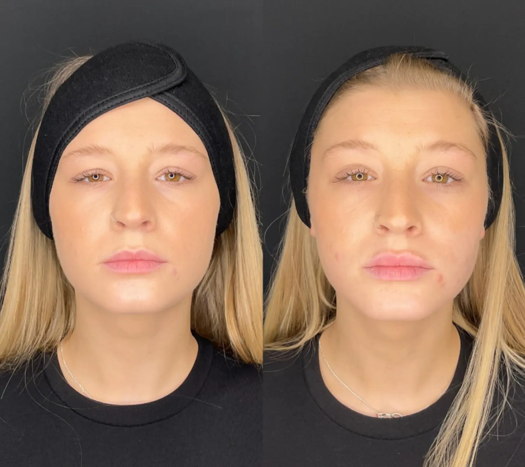 Lip Fillers