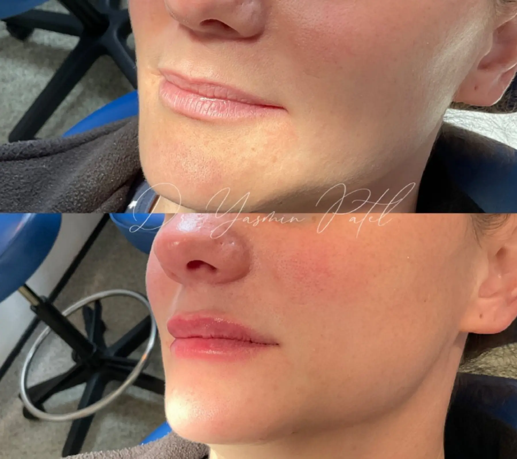 Lip Fillers