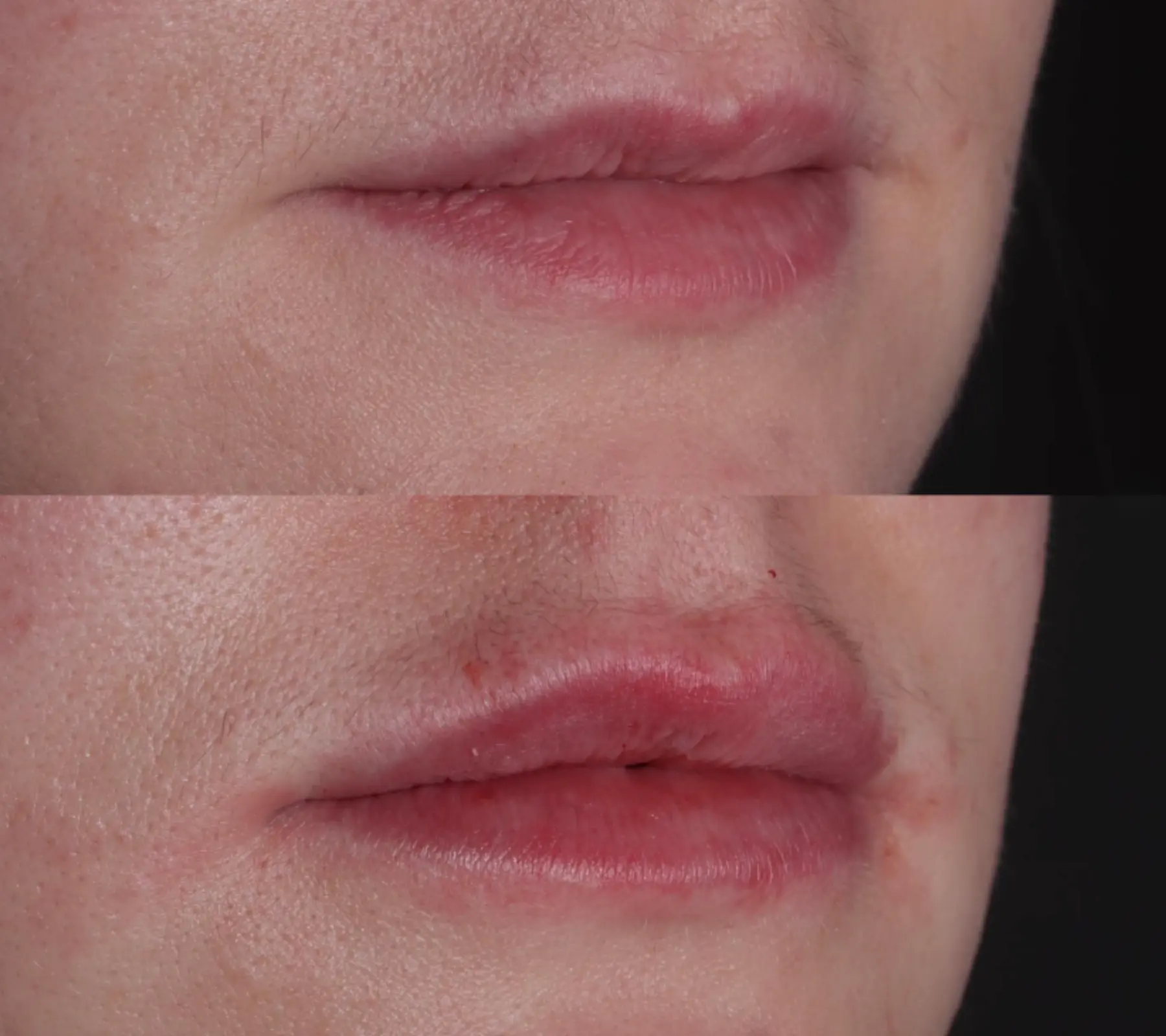 Lip Fillers