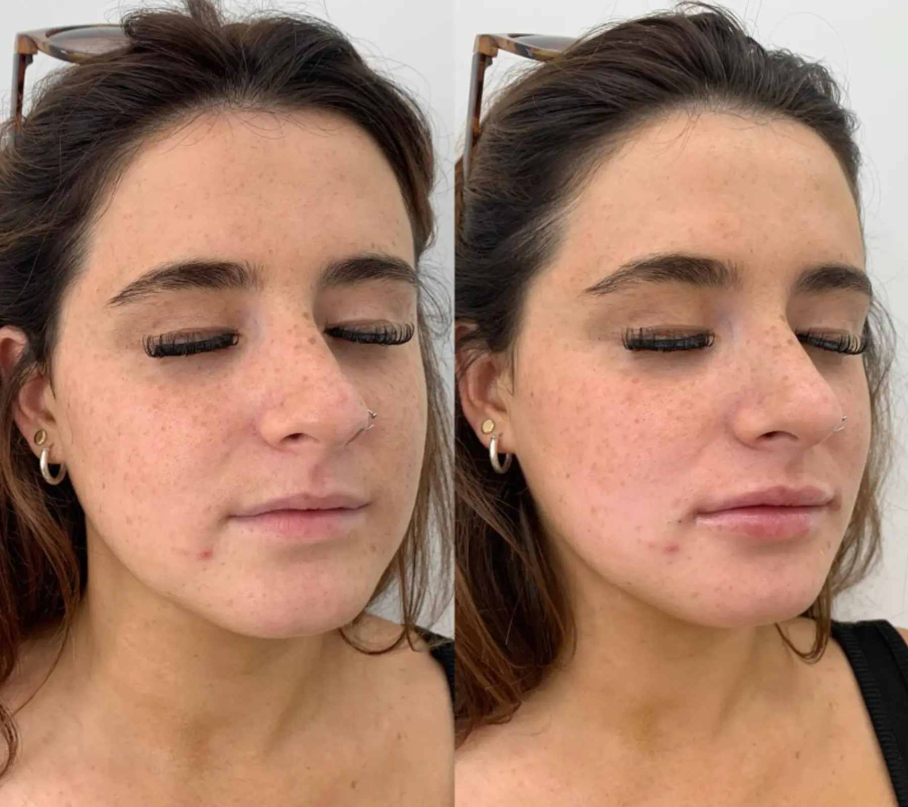 Lip Fillers