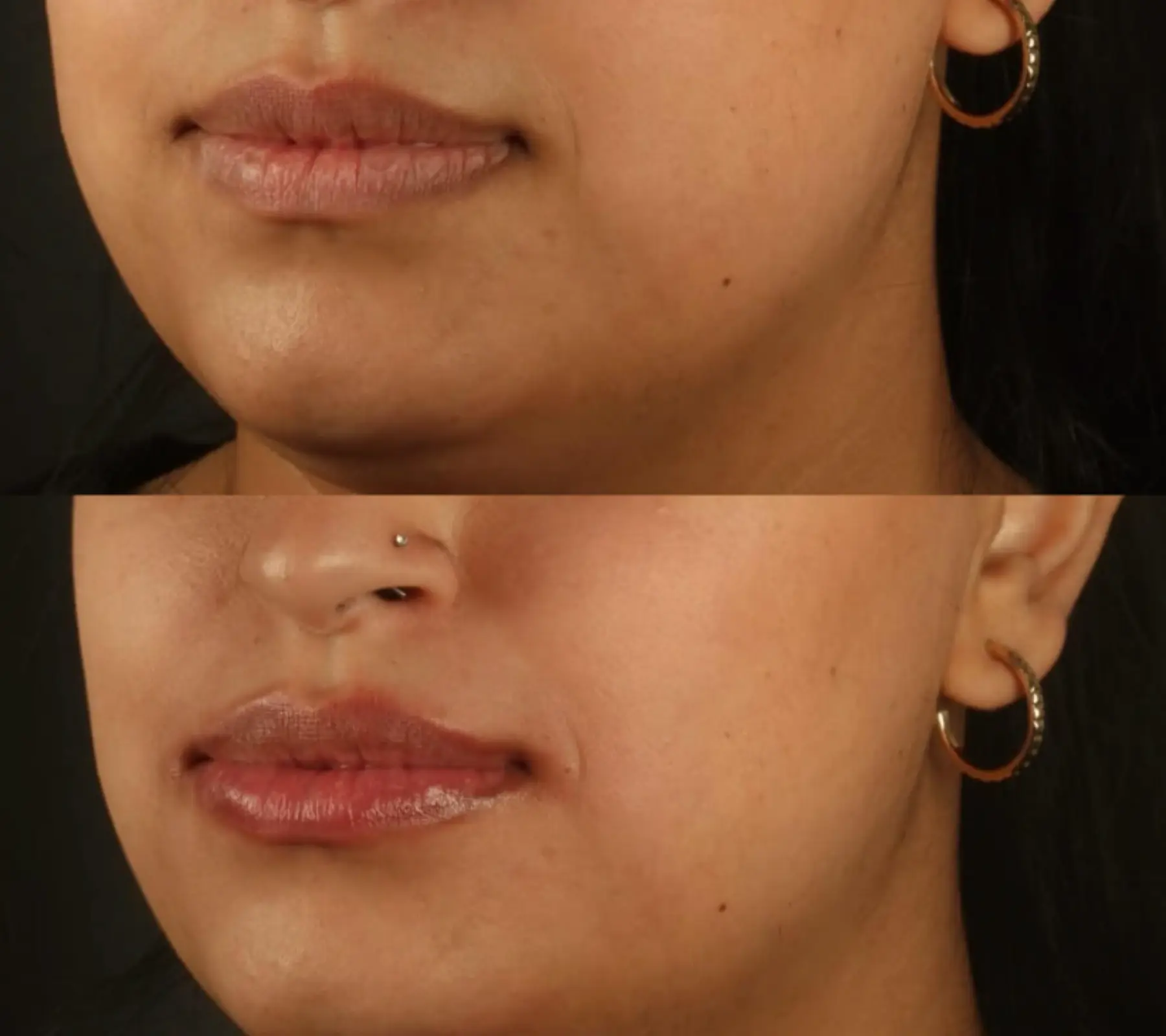 Lip Fillers