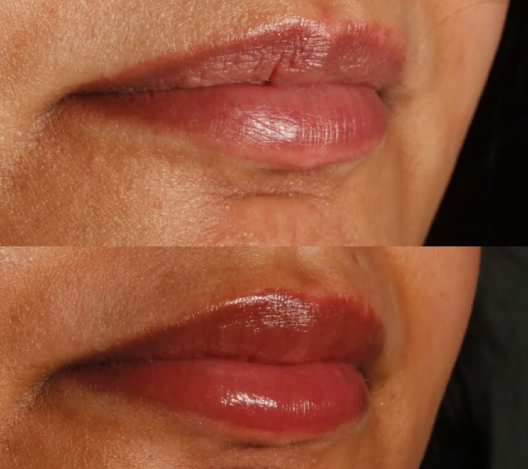 Lip Fillers