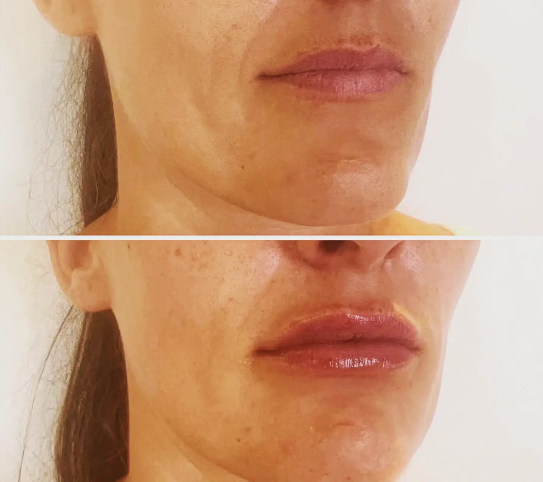 Lip Fillers