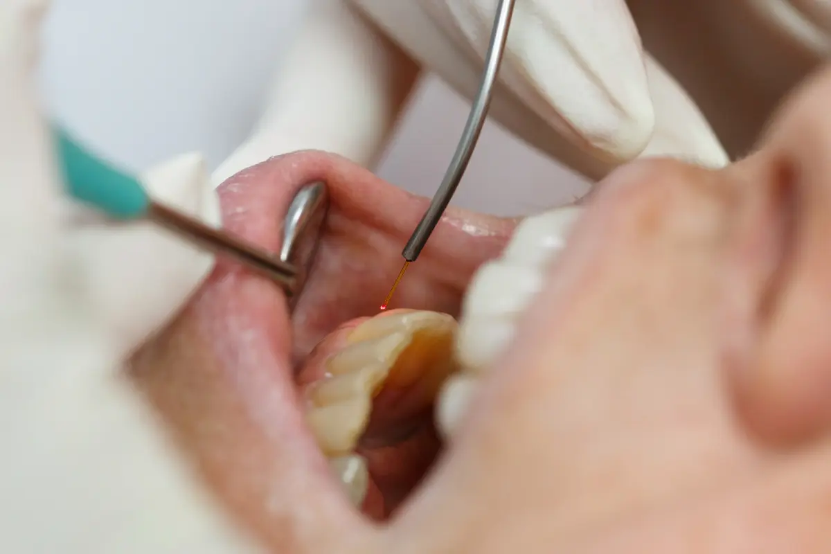 Laser gum treatment Winchester