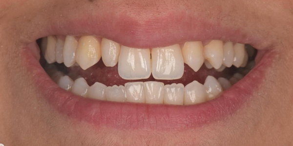 Short teeth