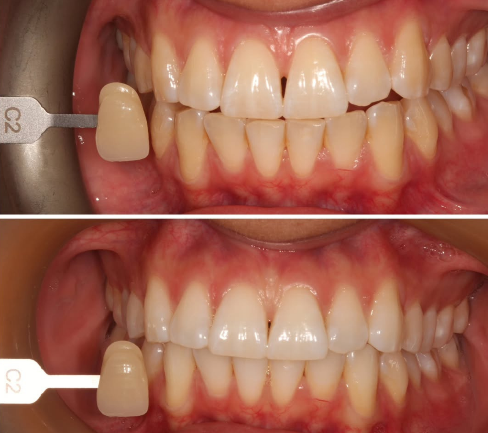 Teeth Whitening