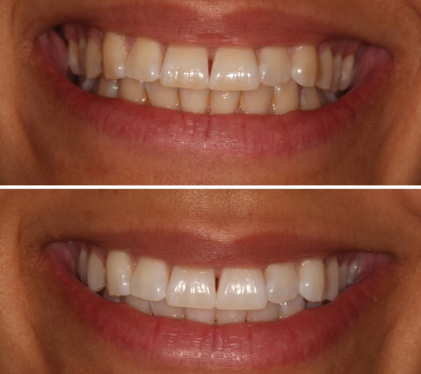 Teeth Whitening