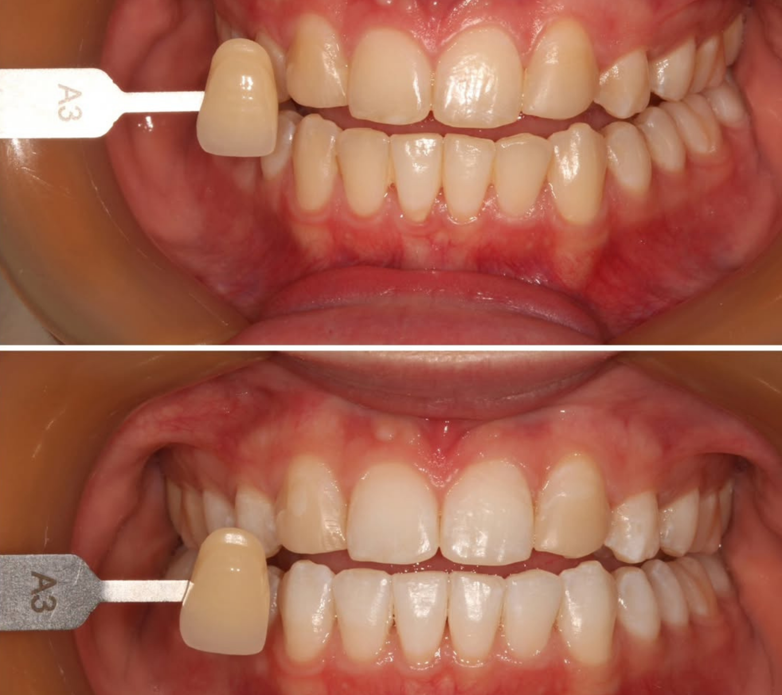Teeth Whitening