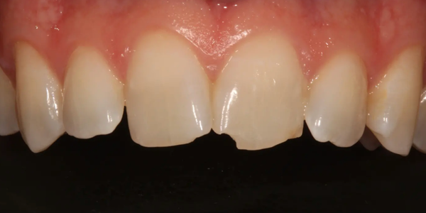 Dental trauma