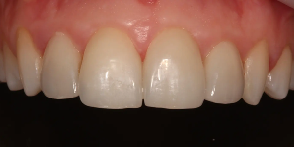 Uneven edges
