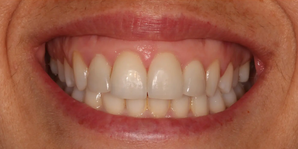 Uneven smile
