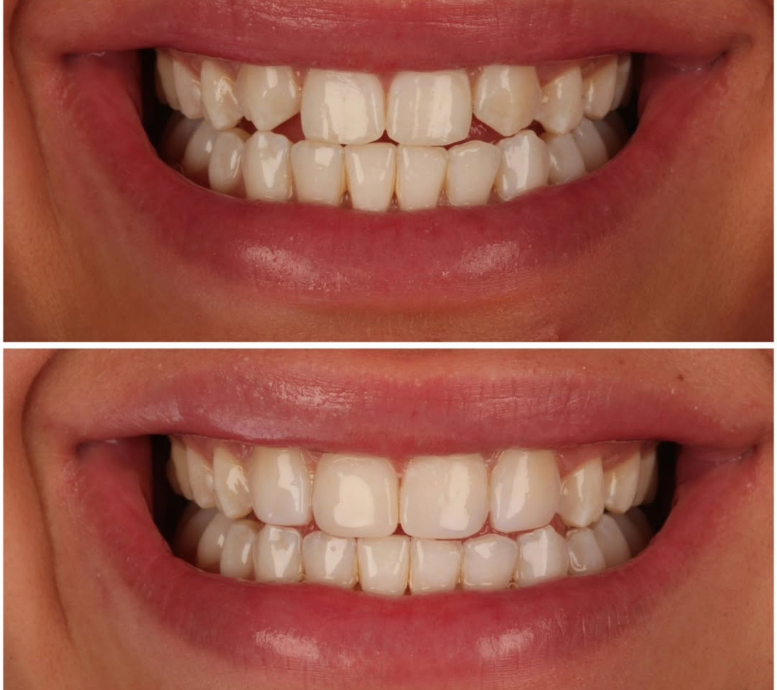 Whitening & Bonding